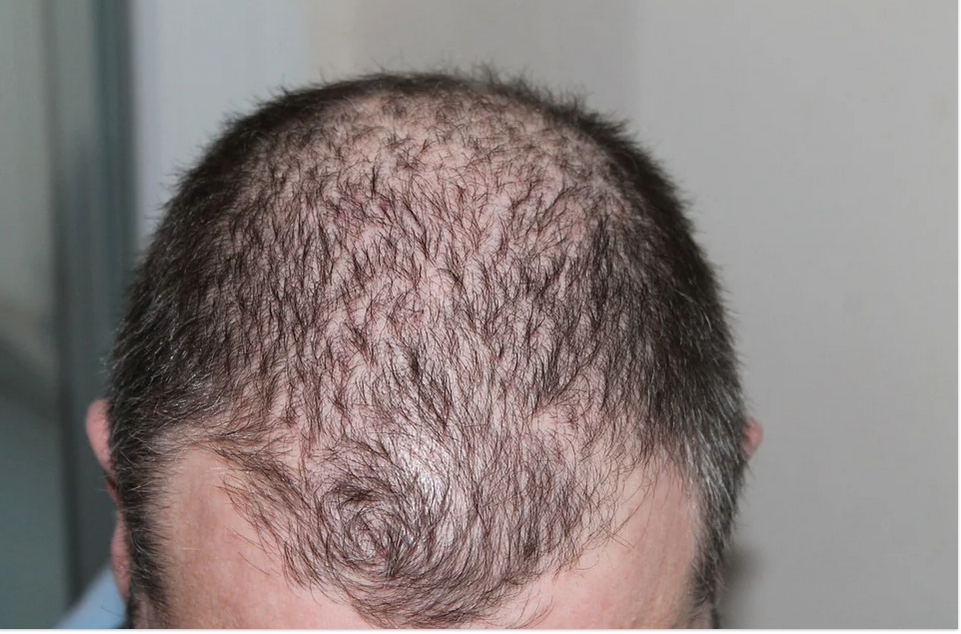 balding or hair loss